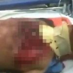 【閲覧注意】事故により胸が裂かれて “動く肺が丸見え” になってしまったグロ動画。