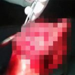 【閲覧注意】手榴弾でグチャグチャになった足を縫合手術するグロ動画。