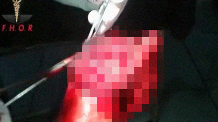 【閲覧注意】手榴弾でグチャグチャになった足を縫合手術するグロ動画。