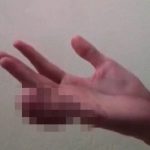 【衝撃映像】小指だけがとんでもなく腫れ上がってしまった人間。