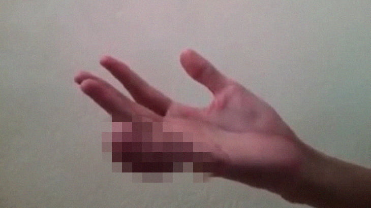 【衝撃映像】小指だけがとんでもなく腫れ上がってしまった人間。