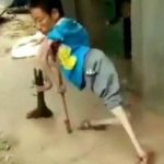 【衝撃映像】両肘・両膝の “関節が逆” になっている奇形の男性。