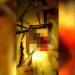 【閲覧注意】19歳の女の子の胃から2kgの髪の毛を摘出。