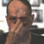 【閲覧注意】ガンにより左目と鼻を失ってしまった男性。
