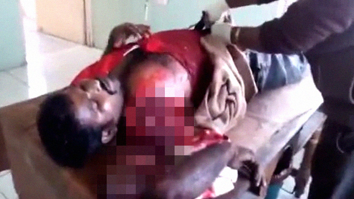 【閲覧注意】事故で右腕が切断された男性、めちゃくちゃ落ち着いてる･･･。