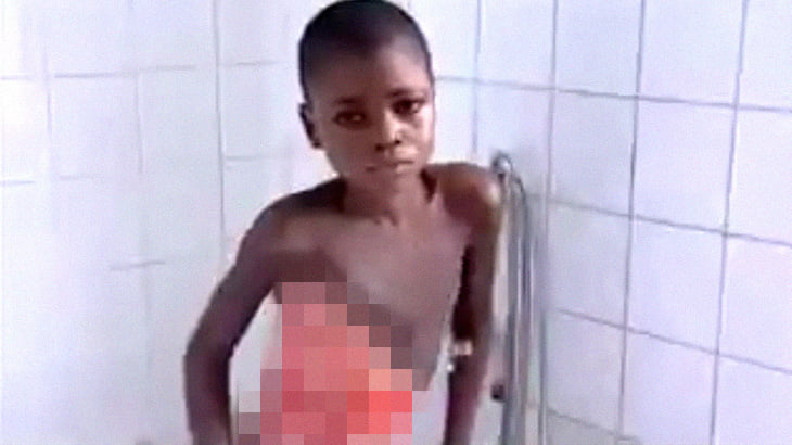 【衝撃映像】身体の肉を食われてしまう病気にかかってしまった男の子。