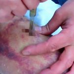 【閲覧注意】雪山で脚を怪我した男性、自らナイフで脚を裂き手術する映像。