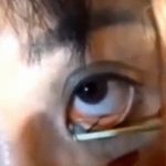 【衝撃映像】目に寄生したワームを自分で取り除く女性。