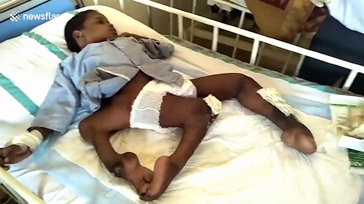 【衝撃映像】3本足で産まれてきた11歳の少年。