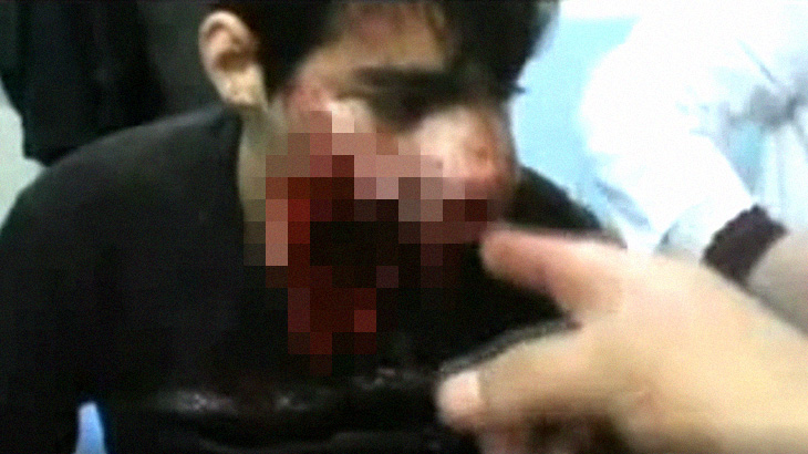 【閲覧注意】アゴを吹き飛ばされてしまった少年のグロ動画。