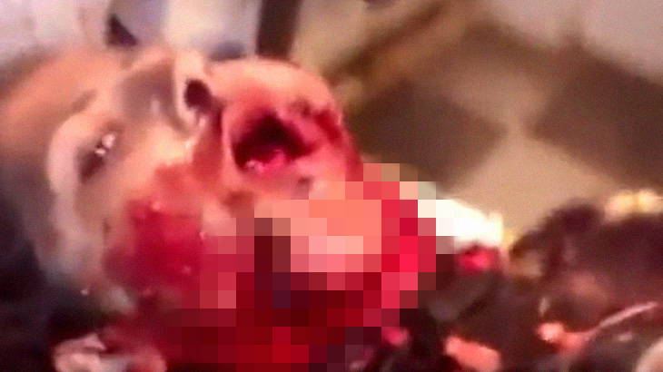 【閲覧注意】アゴが崩壊して苦しむ女性･･･。