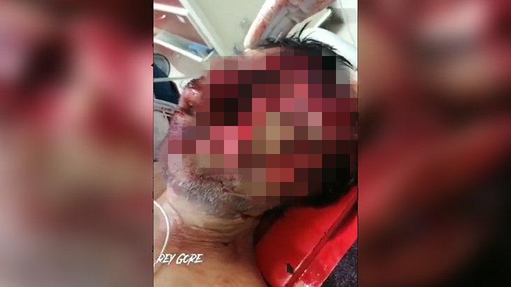 【超！閲覧注意】顔が “縦に割れて目玉が飛び出した” この男性、まだ生きてる･･･。