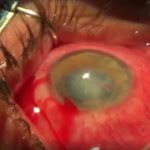 【閲覧注意】眼球を手術する様子を撮影した映像。