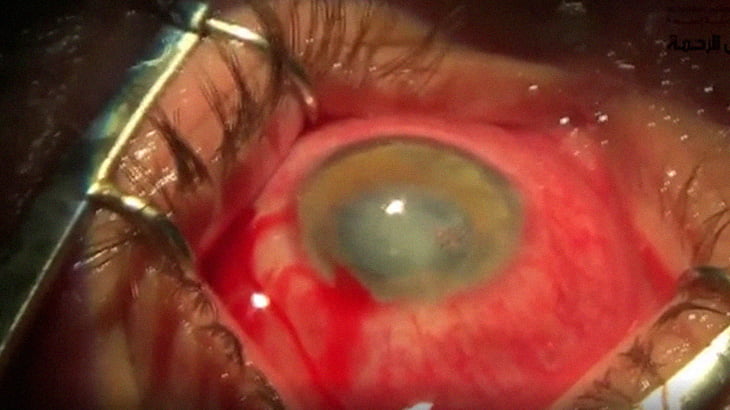 【閲覧注意】眼球を手術する様子を撮影した映像。
