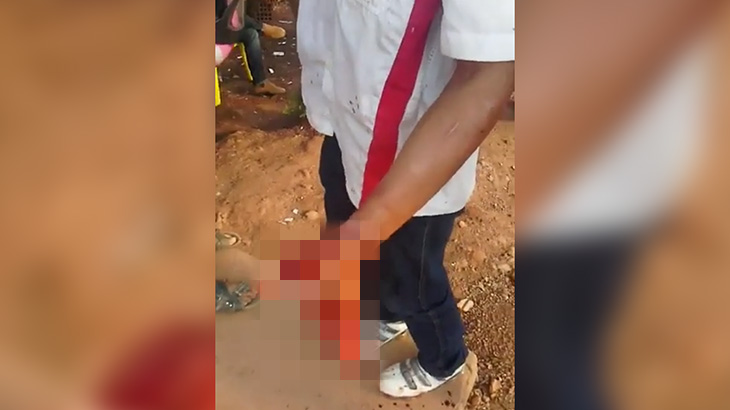 【閲覧注意】花火の暴発で “左手が吹き飛ばされた” 男･･･。