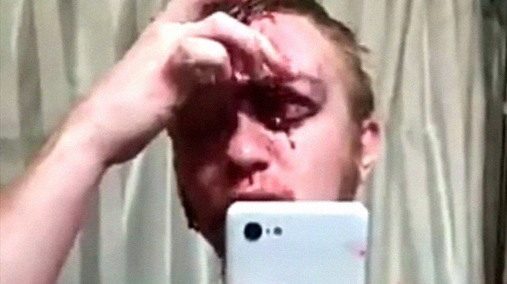 【閲覧注意】自動車事故により、おでこの皮膚がめくれてしまった男性･･･。