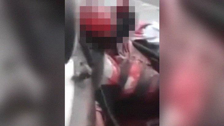 【閲覧注意】車のバンパーに頭をぶつけて “頭皮が剥がれてしまった” 男･･･。