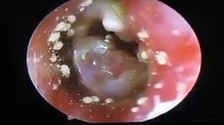 【衝撃映像】耳の中を大量のシラミに寄生されてしまった人間･･･。
