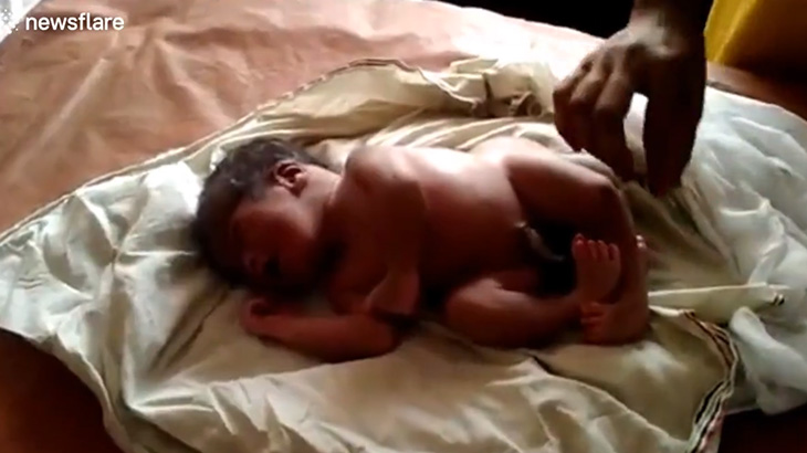 【衝撃映像】4本脚で産まれてきた赤ちゃん。