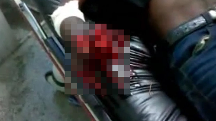 【閲覧注意】爆竹で右手を吹き飛ばされてしまった男のグロ動画。