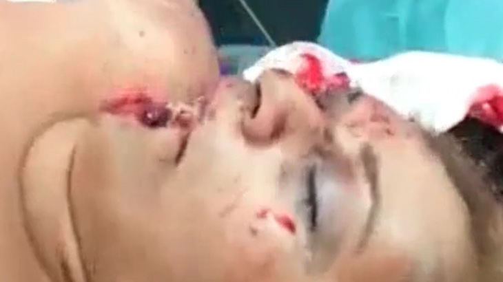 【閲覧注意】顔の右半分が剥がれてしまった女性のグロ動画。まだ生きてる･･･。