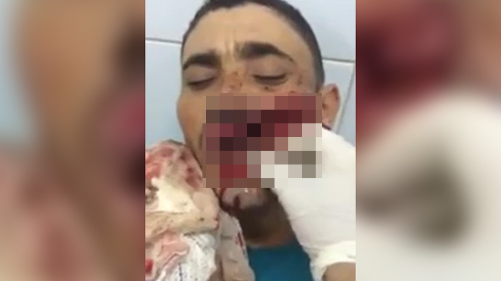 【閲覧注意】ライフルで顔を抉られてしまった男のグロ動画。