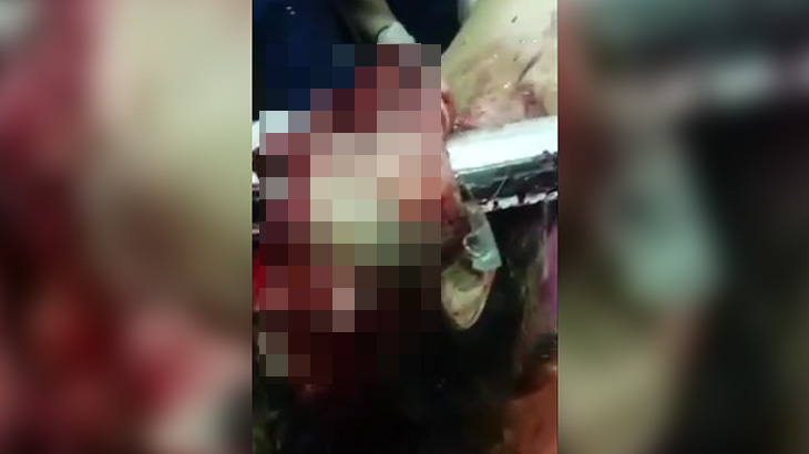 【超！閲覧注意】棒状の鉄が顔に突き刺さり目玉が飛び出た男、これでもまだ生きてる･･･。