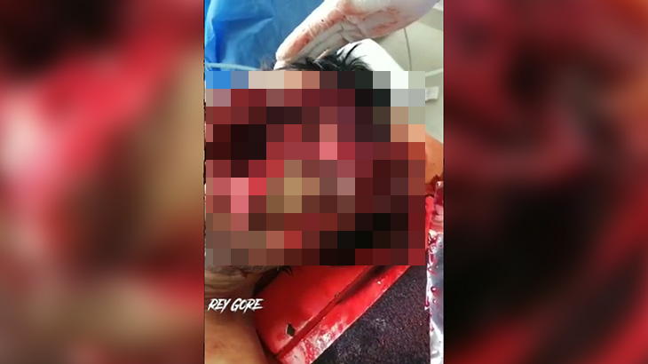【超！閲覧注意】顔をズタズタにされて左眼球が剥き出しになってしまった男のグロ動画･･･。