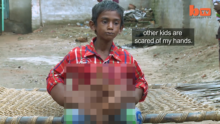【衝撃映像】巨大な手を持ったインドの少年。