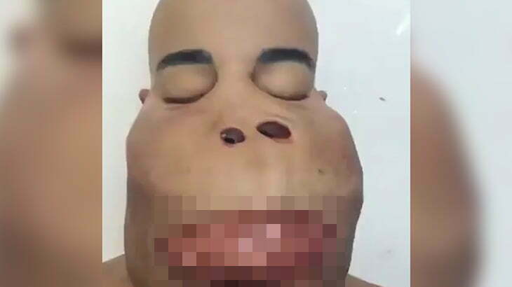 【超！閲覧注意】まるで “リアルカバ夫” のように顔が膨れてしまった男の死体･･･。