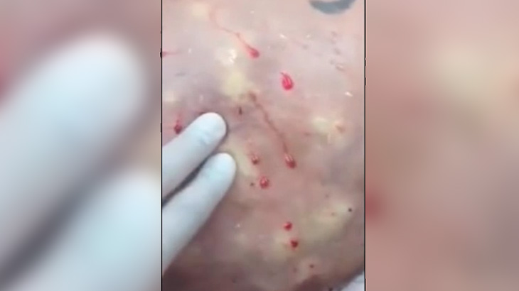 【閲覧注意】シリコン注入手術に失敗したお尻、ヤバイことになってしまう･･･。