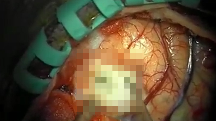 【閲覧注意】脳にできた “謎の白い物質” を摘出する手術映像。