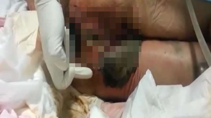 【閲覧注意】お尻が腐ってしまった人間･･･。