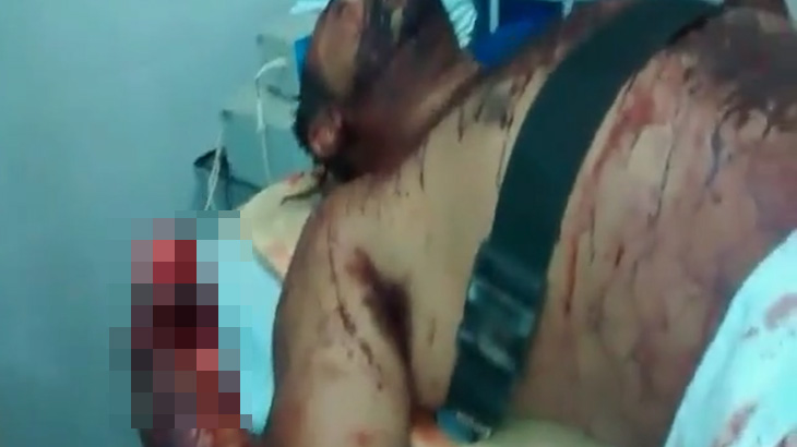【閲覧注意】マチェーテで両手を切断されてしまった男のグロ動画･･･。