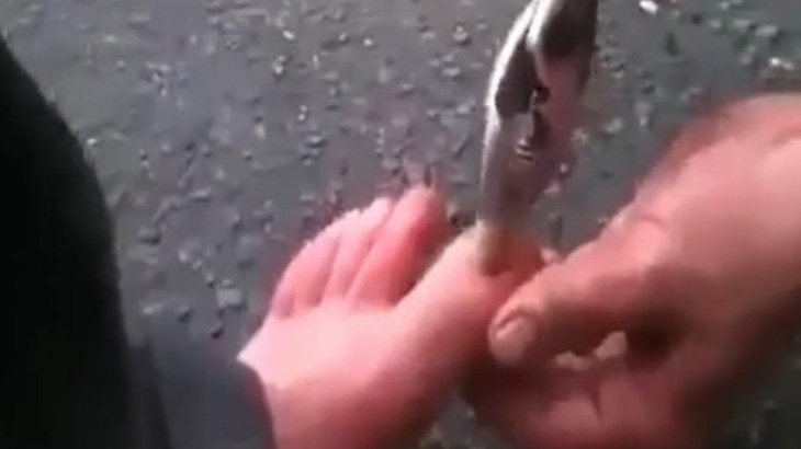 【閲覧注意】腐った足の爪を “ペンチで引っこ抜く” めっちゃ痛そうな映像･･･。