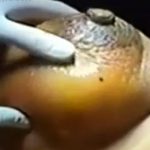 オッパイから大量の膿を摘出する手術映像。