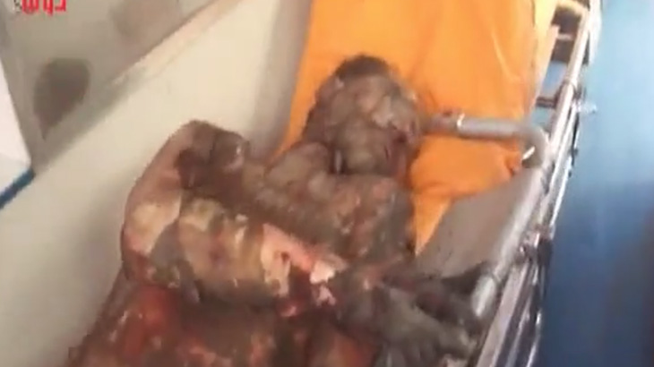 【閲覧注意】空爆を受けた男、腸がまるごと飛び出してしまう･･･。