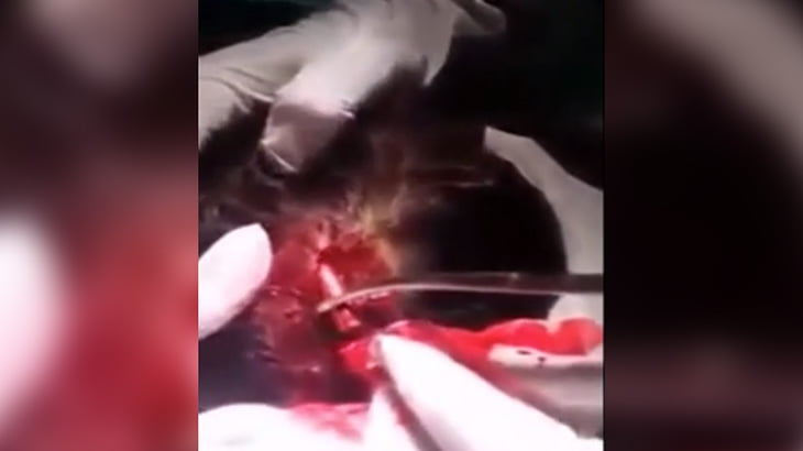 【閲覧注意】銃で狙撃された女の子の頭から麻酔なしで銃弾を摘出する映像･･･。