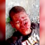 【閲覧注意】銃撃された男、顔に穴が開いてしまうものの奇跡的に生き残る。