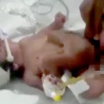 【衝撃映像】”4つの脚” を持って生まれてきた新生児。