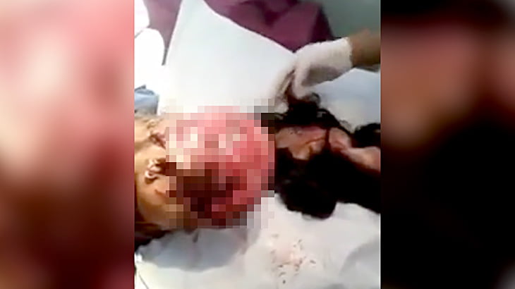 【閲覧注意】事故で頭皮がまるごとズル剥けてしまった女性のグロ動画。