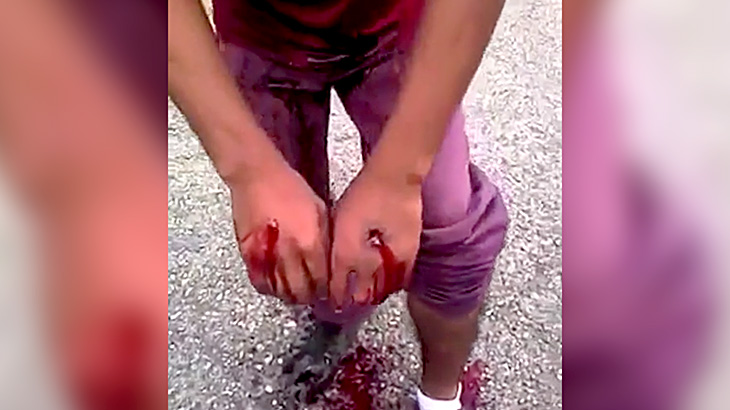 泥棒の男、罰として両手とふくらはぎを銃で撃たれてしまう。