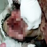 【閲覧注意】ショットガンで顔を破壊された女性を手術するグロ動画。