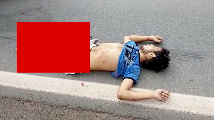 【閲覧注意】トラックに轢かれた男性の両脚、皮膚が剥がれて筋繊維がむき出しになってしまう･･･。