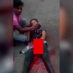 【閲覧注意】事故で左手が破壊されてしまった女の子のグロ動画。