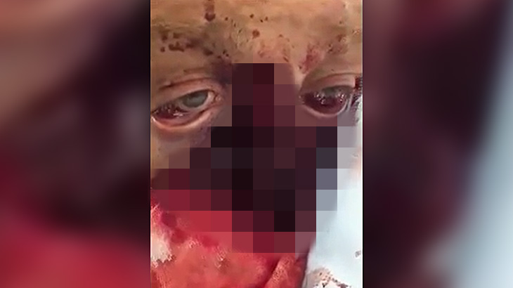 【閲覧注意】鼻と口が剥がれて動く舌が丸見えになってしまった男、こんな状態でもまだ生きているグロ動画。