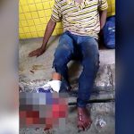 【閲覧注意】事故で右足を完全に?壊されてしまった男性。