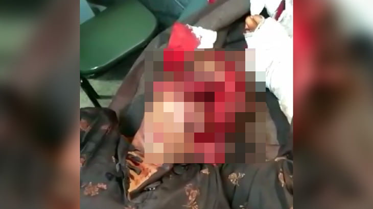 【超！閲覧注意】ピットブルに顔をグチャグチャにされてしまった女性、この状態でも生きてる･･･。