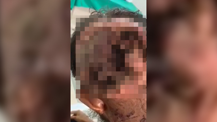 【閲覧注意】後頭部をウジ虫に食われてしまっている男性のグロ動画。