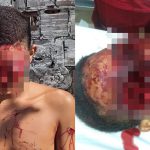 【閲覧注意】ショットガンで両目を吹き飛ばされた状態で生き延びてしまった男のグロ画像。